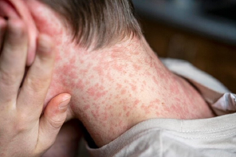 Một số câu hỏi về bệnh Sởi